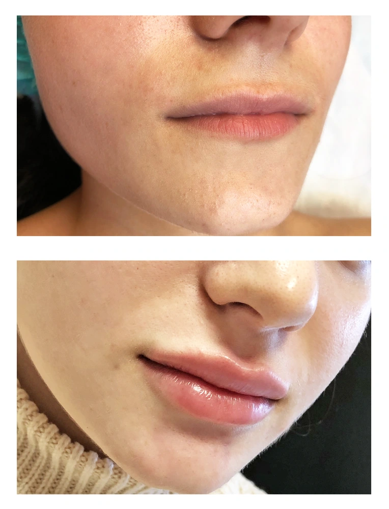 lips 1 - Коррекция нижней трети лица