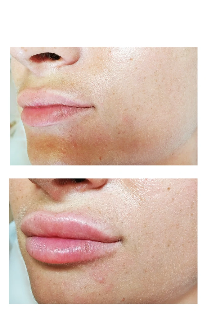 lips 10 - Коррекция нижней трети лица