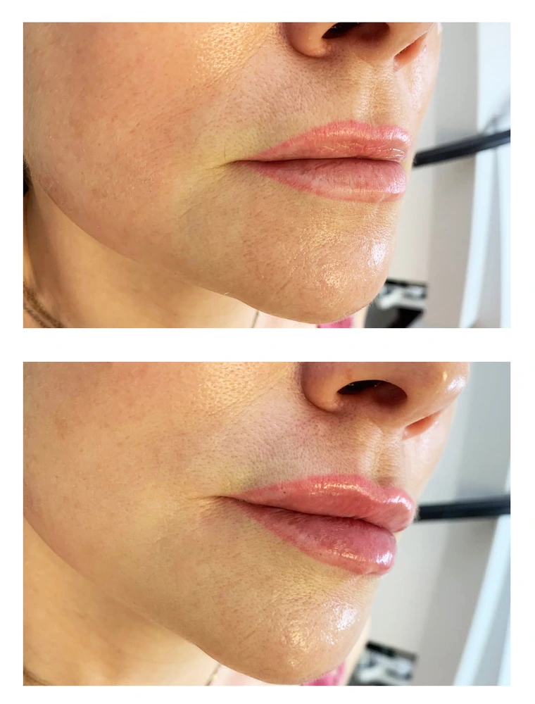 lips 11 - Коррекция нижней трети лица