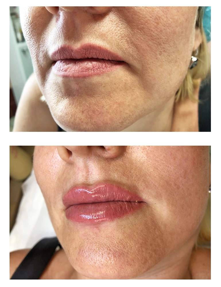 lips 14 - Увеличение губ