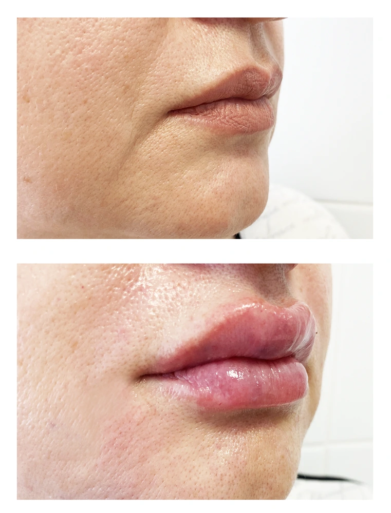lips 15 - Коррекция нижней трети лица