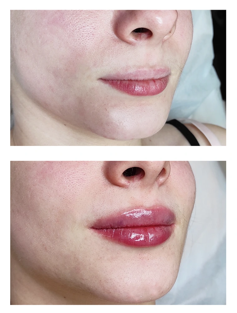 lips 16 - Коррекция нижней трети лица