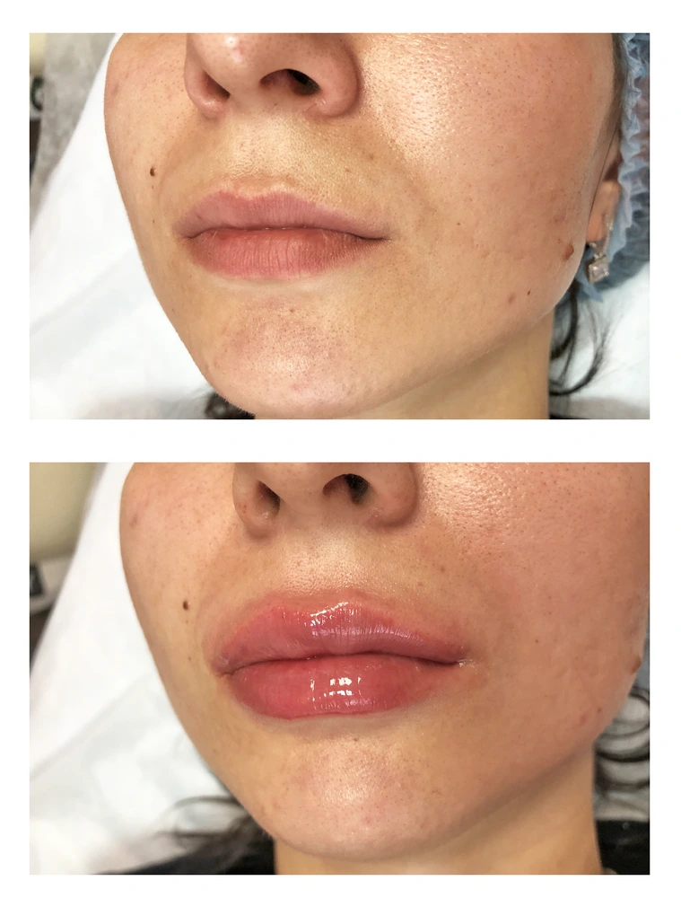lips 17 - Коррекция нижней трети лица