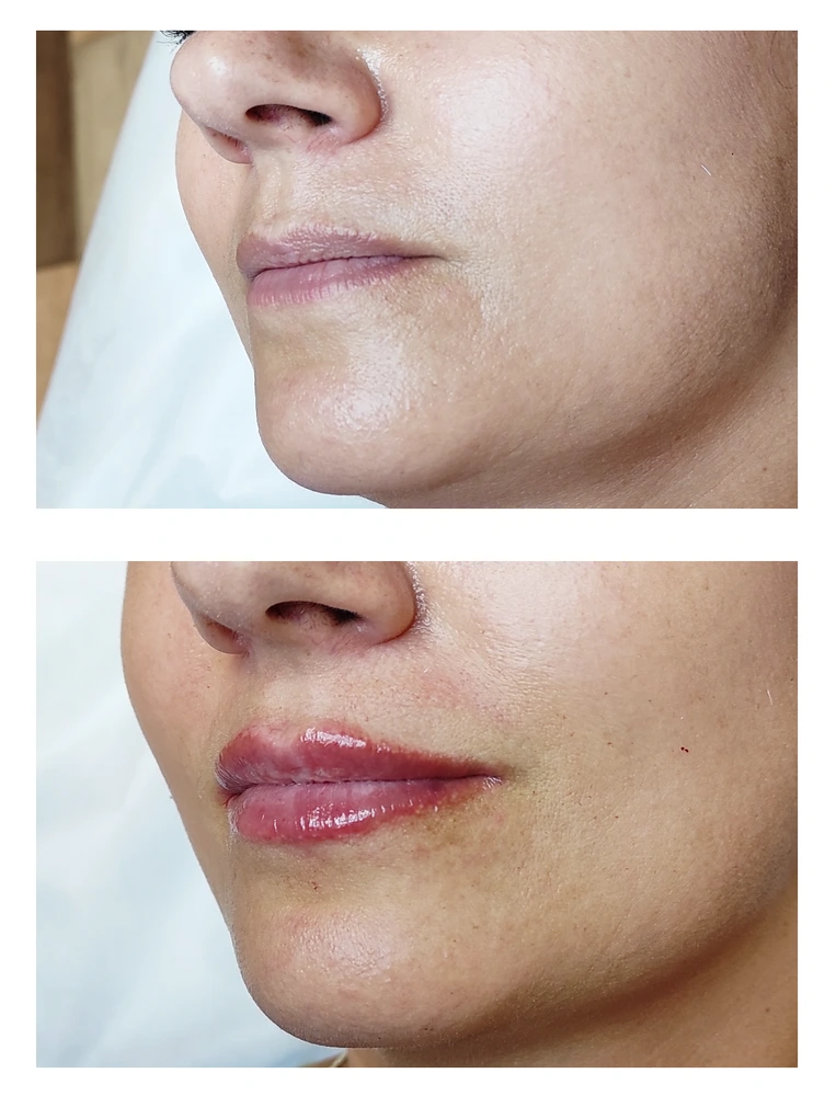 lips 18 - Коррекция нижней трети лица