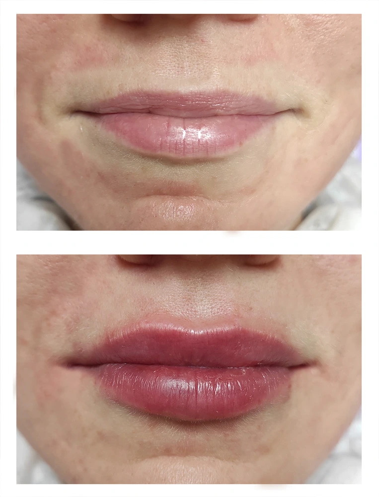 lips 19 - Коррекция нижней трети лица