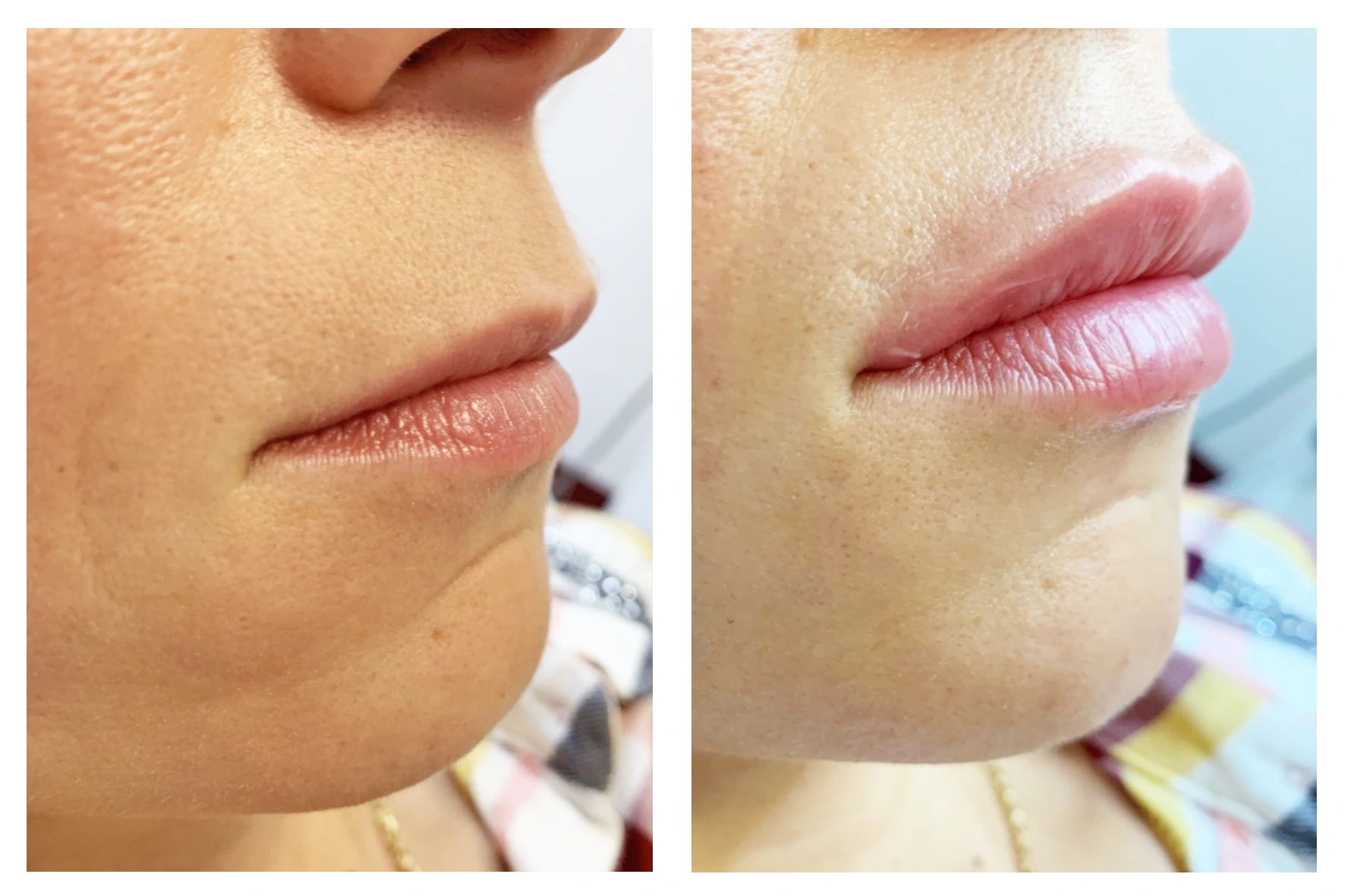lips 2 - Коррекция нижней трети лица
