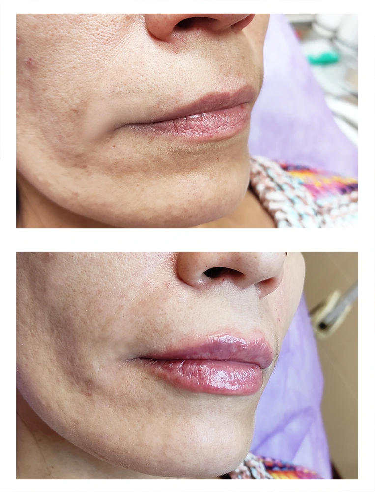 lips 20 - Коррекция нижней трети лица