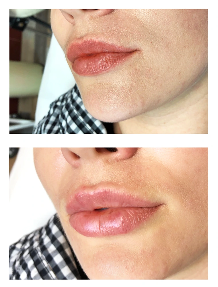 lips 21 - Коррекция нижней трети лица