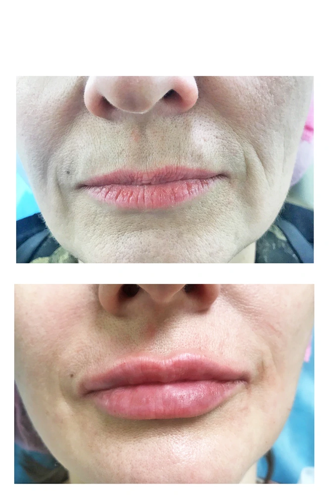 lips 3 - Коррекция нижней трети лица