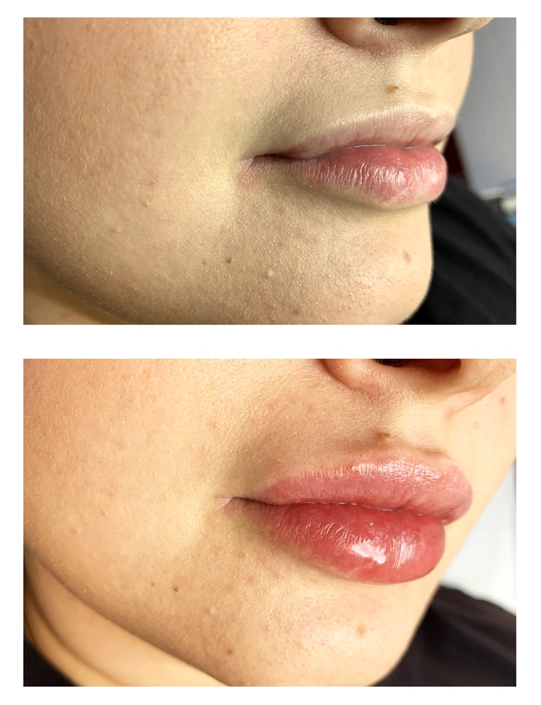 lips 4 - Коррекция нижней трети лица