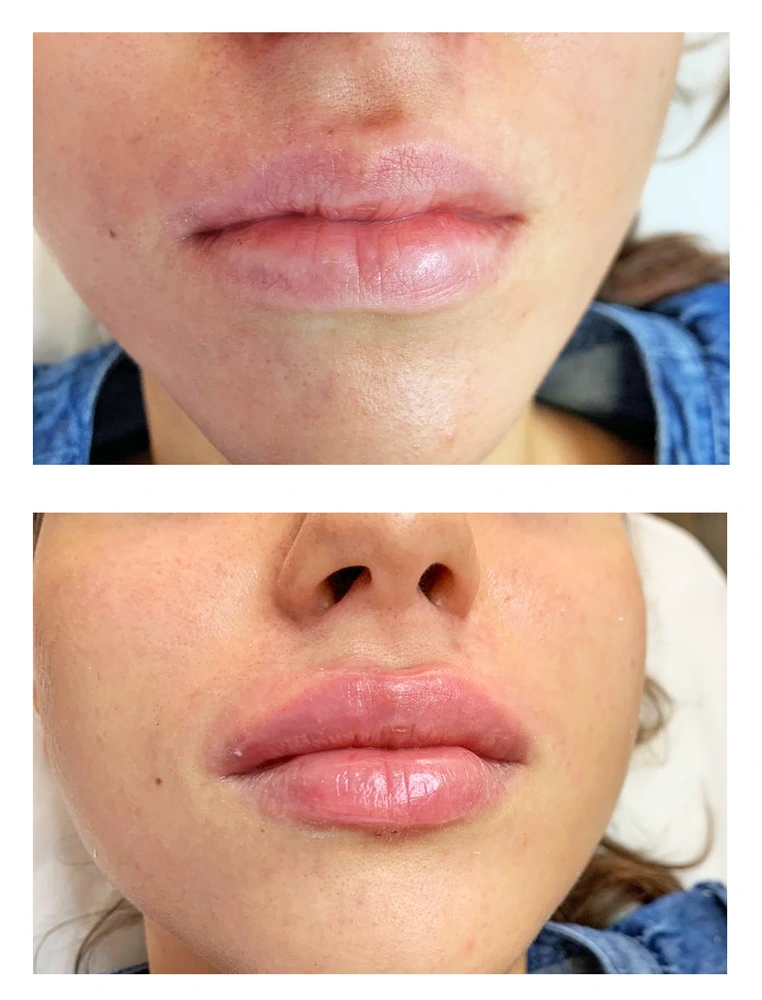 lips 5 - Коррекция нижней трети лица