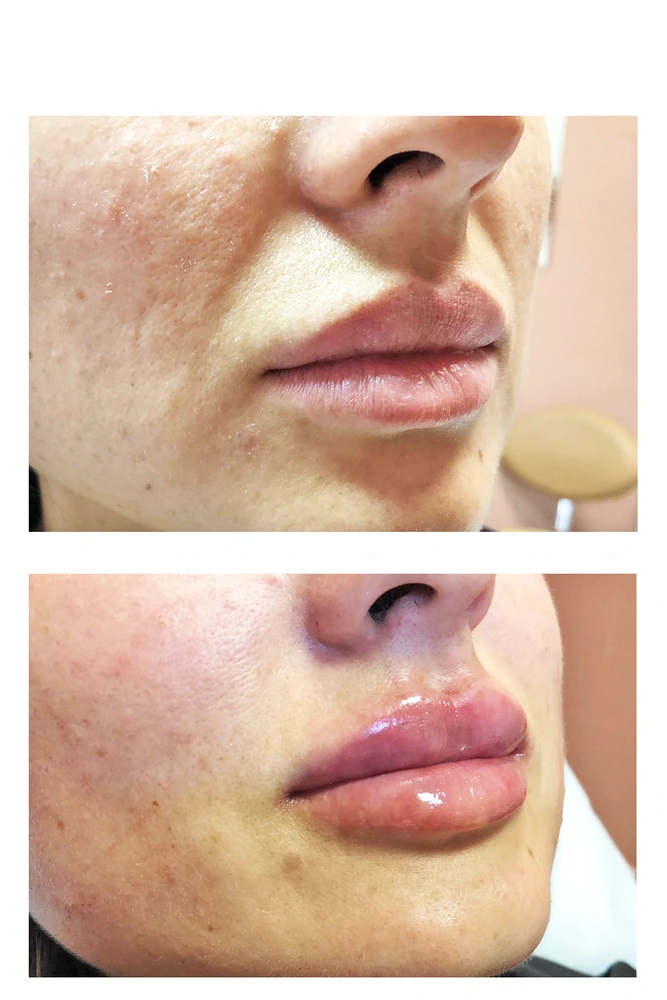 lips 6 - Коррекция нижней трети лица
