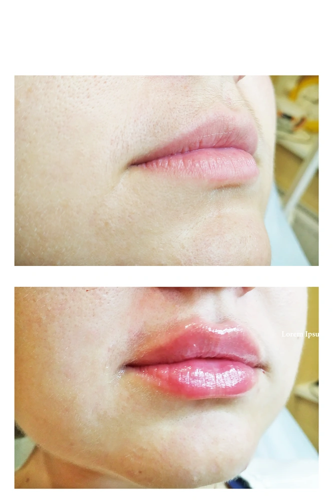 lips 7 - Коррекция нижней трети лица