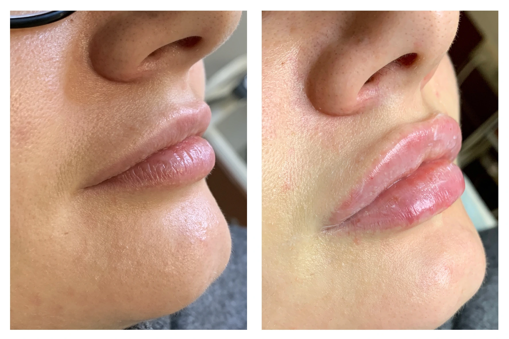lips 8 - Увеличение губ