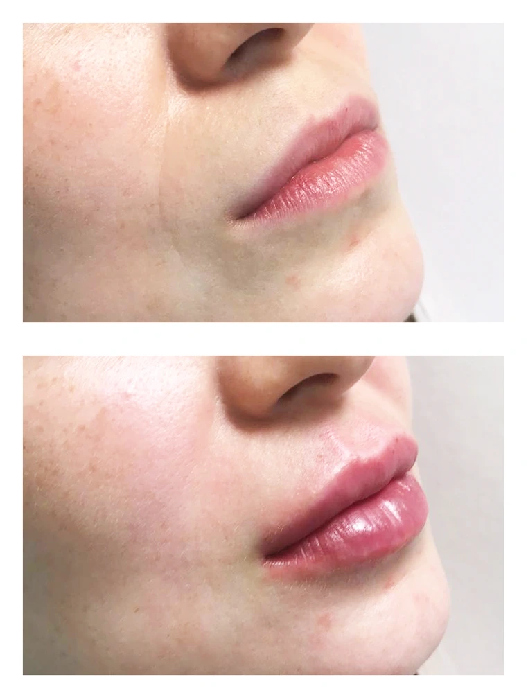 lips 9 - Коррекция нижней трети лица